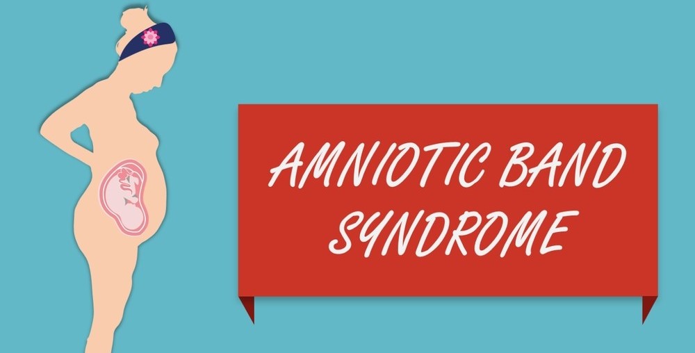 Amniotic Band Syndrome Causes, Symptoms & Treatment
